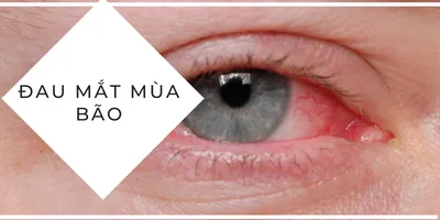 Tại sao dễ bị đau mắt mùa bão lũ