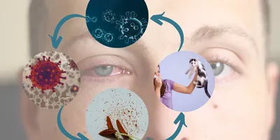 Nguyên nhân đau mắt đỏ và phương pháp điều trị
