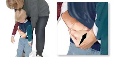 Cách xử trí nhanh khi trẻ hóc các loại hạt