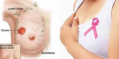 NHỮNG ĐIỀU BẠN CẦN BIẾT VỀ '' UNG THƯ VU