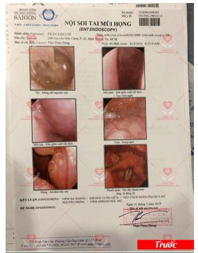 Chị Kim Chi xoang 10 năm trước khi dùng Tân Di Hoa
