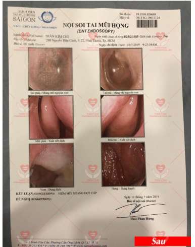 Chị Kim Chi xoang 10 năm sau khi dùng Tân Di Hoa