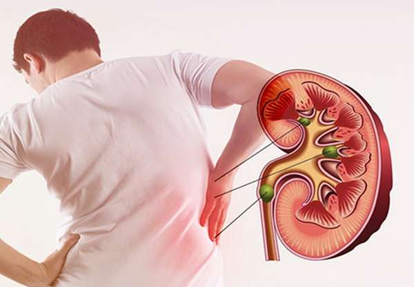 biến chứng sỏi thận