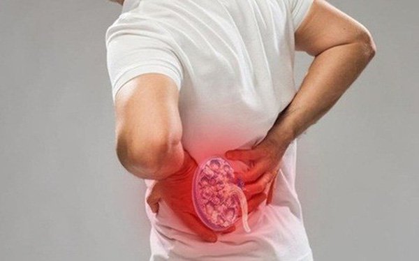 Cơn đau sỏi thận