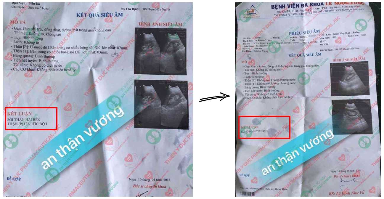 Kết quả siêu âm thận trước và sau khi dùng An Thận Vương