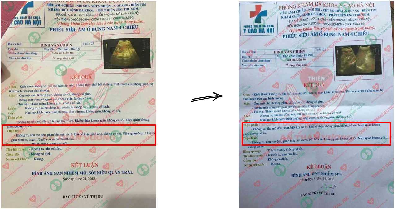 Kết quả siêu âm thận trước và sau khi dùng An Thận Vương