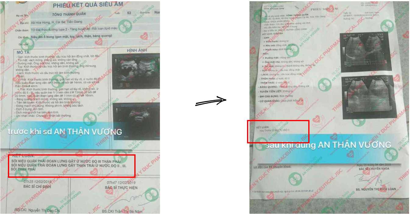 Kết quả siêu âm thận trước và sau khi dùng An Thận Vương