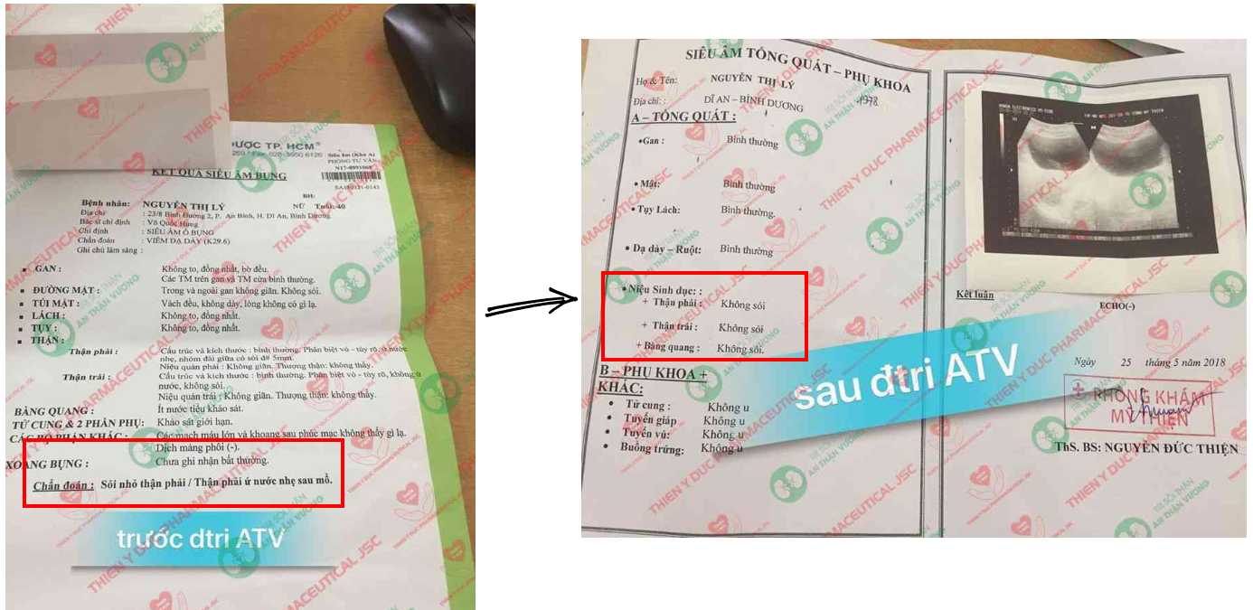 Kết quả siêu âm thận trước và sau khi dùng An Thận Vương
