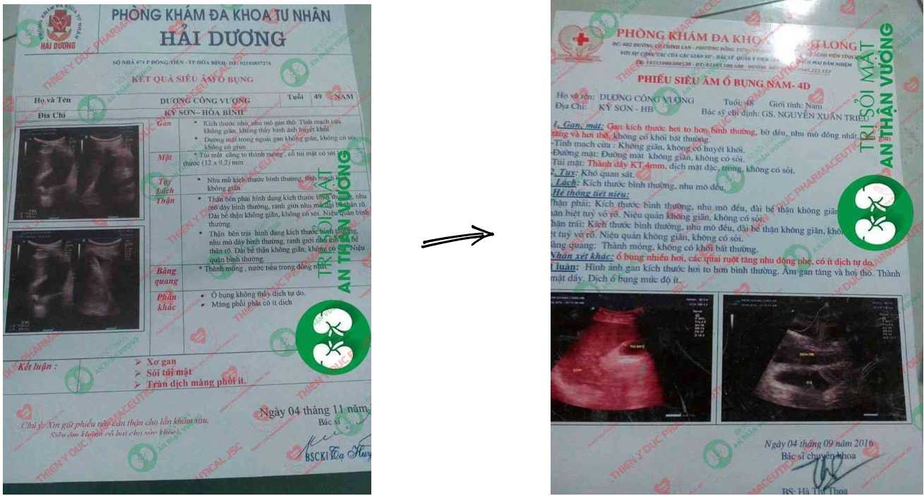 Kết quả siêu âm thận trước và sau khi dùng An Thận Vương