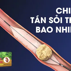 Chi phí tán sỏi thận bao nhiêu tiền là chính xác nhất 2024