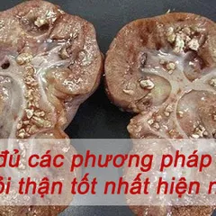 ĐẦY ĐỦ NHẤT các phương pháp chữa sỏi thận TỐT NHẤT hiện nay 2021