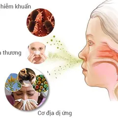 TOP thuốc trị viêm mũi dị ứng hiệu quả nhất bác sĩ khuyên dùng 2021