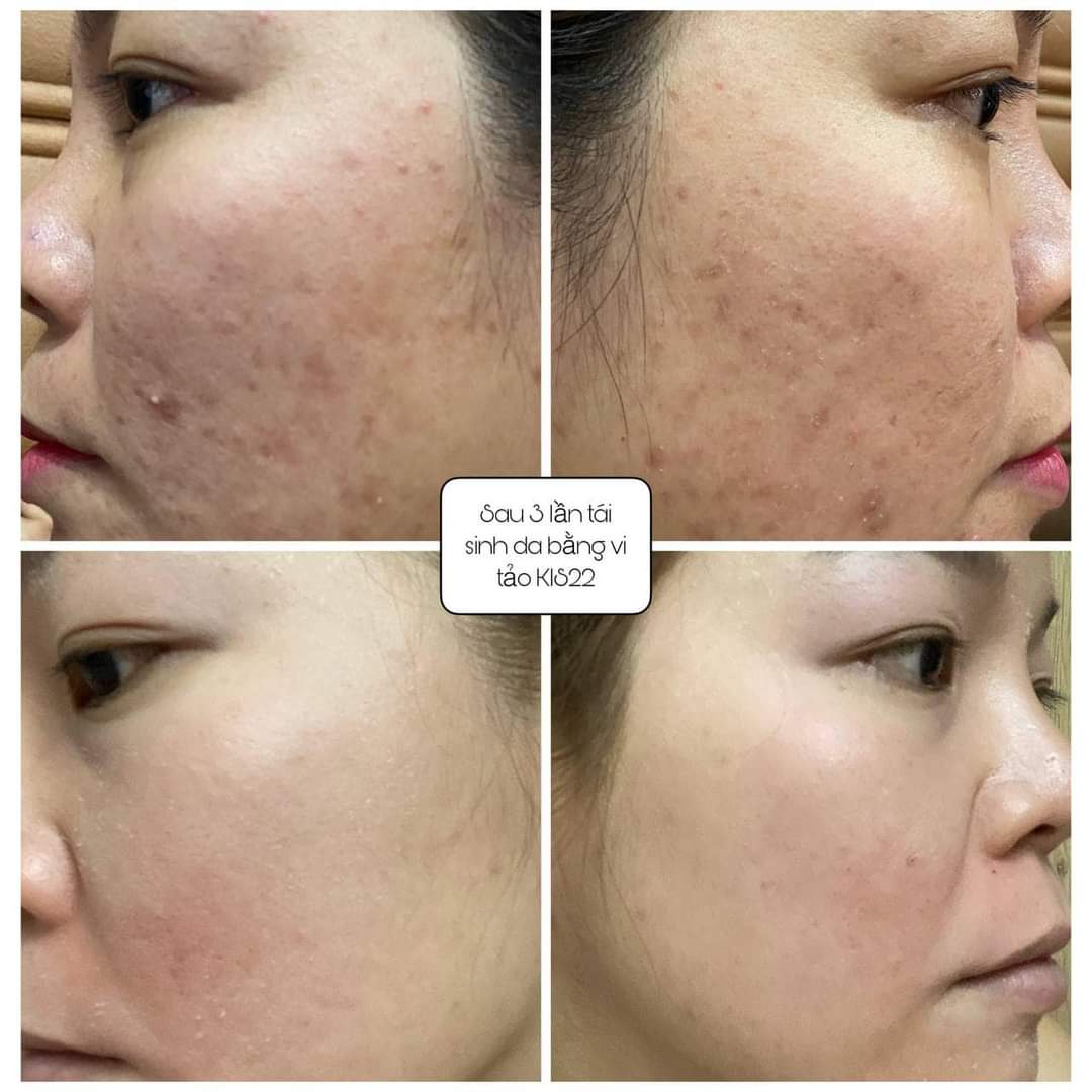 [[Hott]] BIỂU HIỆN KHI DÙNG SERUM TÁI TẠO DA SIÊU VI TẢO GREEN VITA KIS22