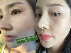 CÁC HIỆN TƯỢNG KHI XÀI TÁI SINH DA SIÊU VI TẢO KIS 22 GREEN VITA