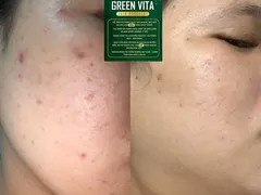 REVIEW SERUM SIÊU VI TẢO GREEN VITA KIS22