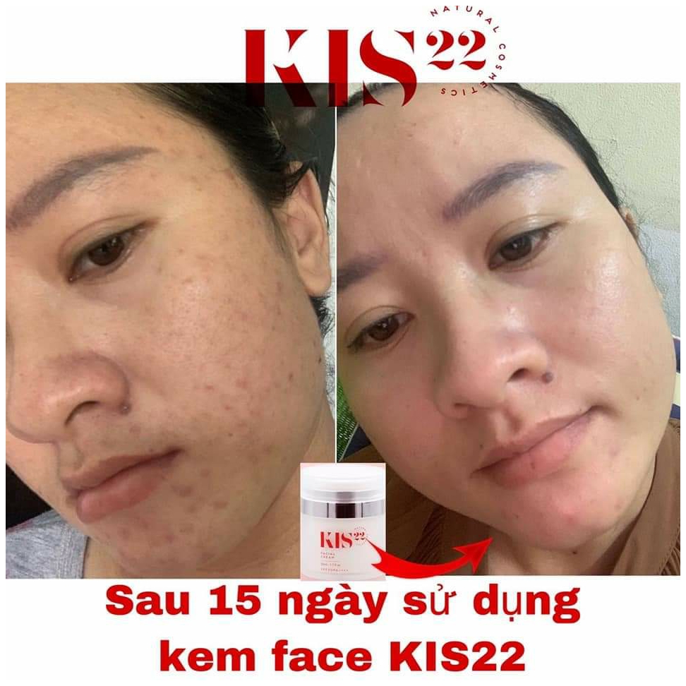 Kem dưỡng trắng da kis22 Kem dưỡng trắng da kis22