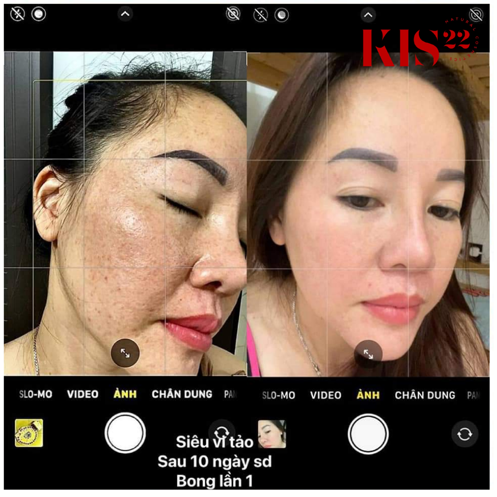 Hình ảnh khách khi sử dụng tái tạo da kis22 Hình ảnh khách khi sử dụng tái tạo da kis22