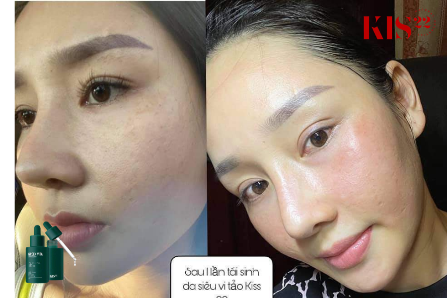 Hình ảnh khách khi sử dụng tái tạo da kis22 Hình ảnh khách khi sử dụng tái tạo da kis22