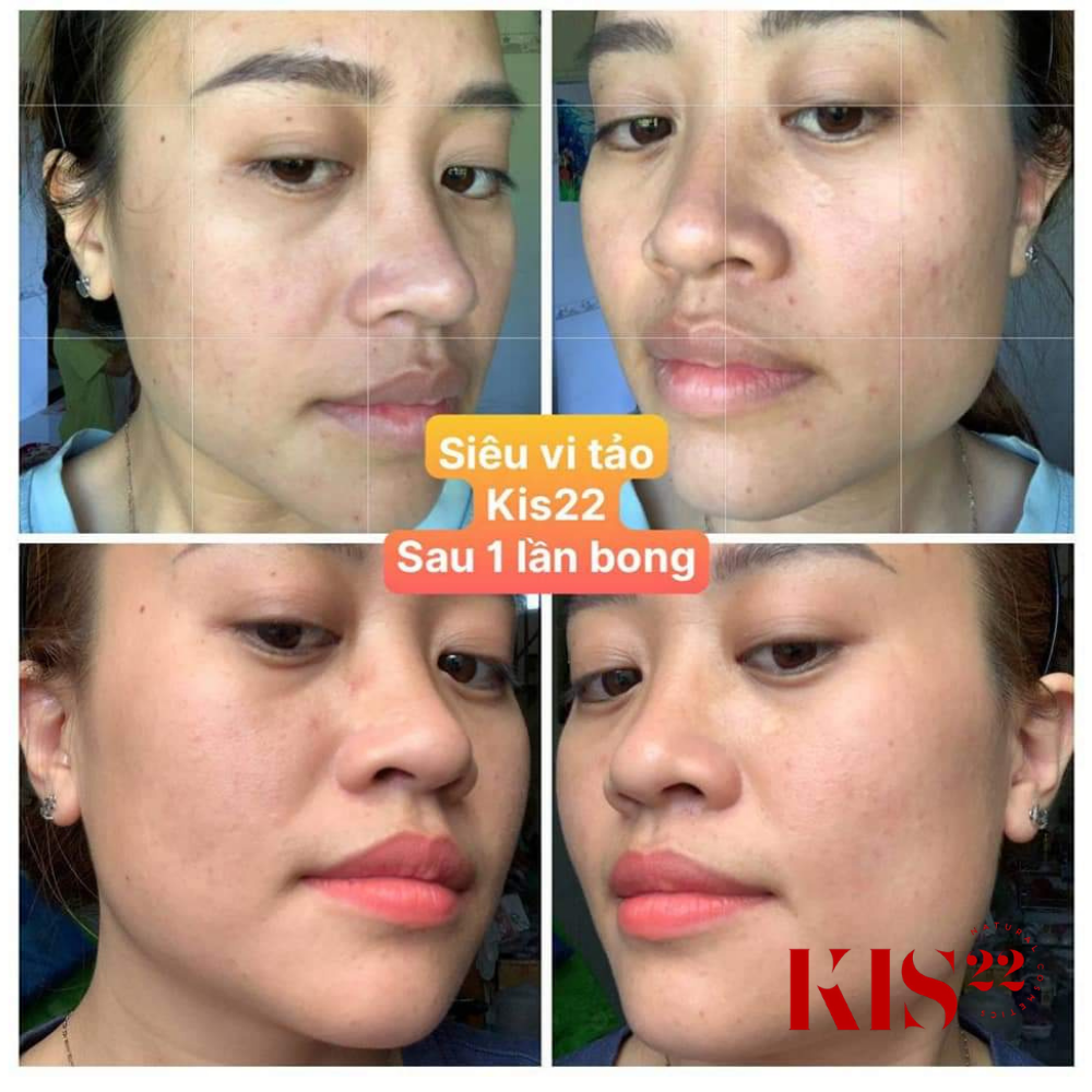Hình khách sử dụng serum tái tạo da vi tảo kis22 Hình khách sử dụng serum tái tạo da vi tảo kis22