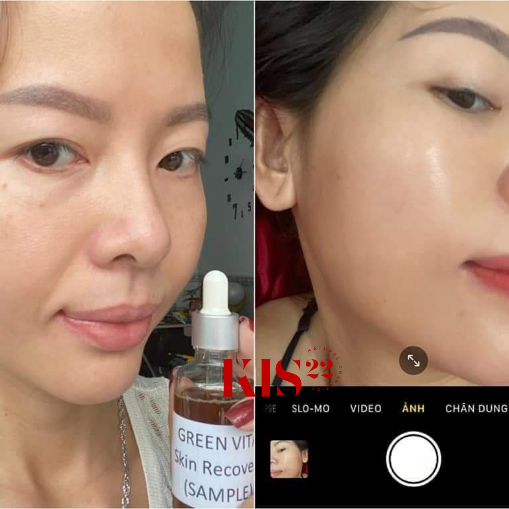 Hình ảnh khách khi sử dụng tái tạo da kis22 Hình ảnh khách khi sử dụng tái tạo da kis22