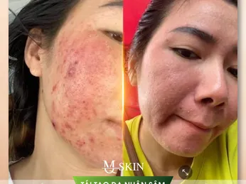 Những biểu hiện khi dùng serum tái tạo da nhân sâm mq skin