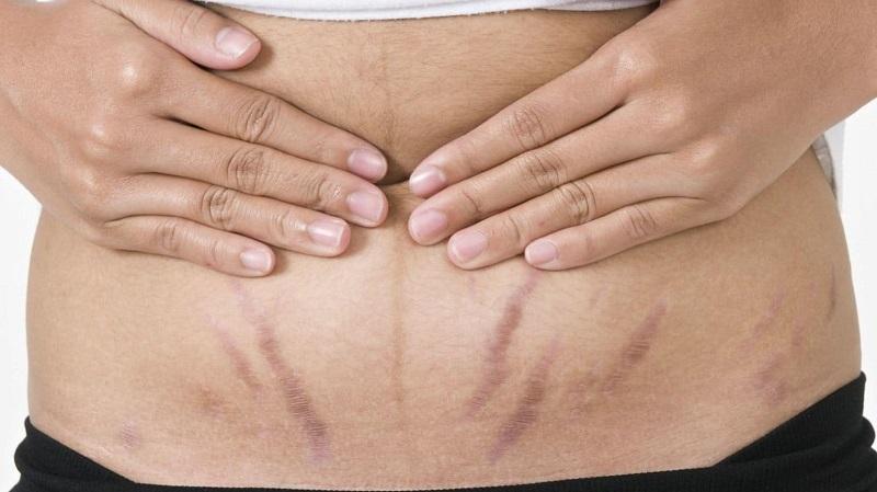 Ăn yến sào có giảm rạn da sau sinh không Ăn yến sào có giảm rạn da sau sinh không
