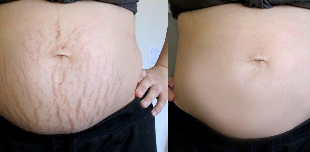 Ăn yến sào có giảm rạn da sau sinh không Ăn yến sào có giảm rạn da sau sinh không