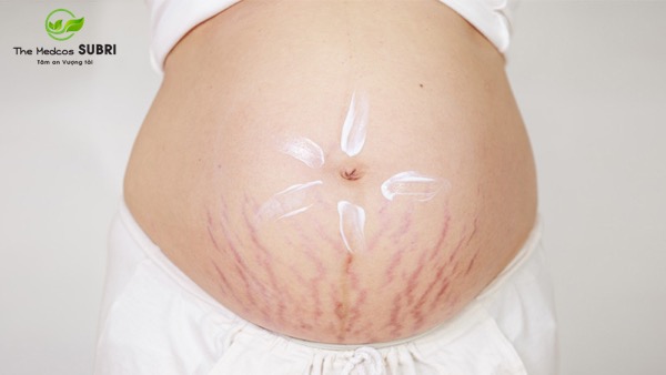 cách trị thâm nám rạn da cho bà bầu cách trị thâm nám rạn da cho bà bầu