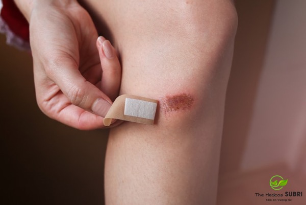 Dùng Nacurgo Gel trong bao lâu có tác dụng Dùng Nacurgo Gel trong bao lâu có tác dụng