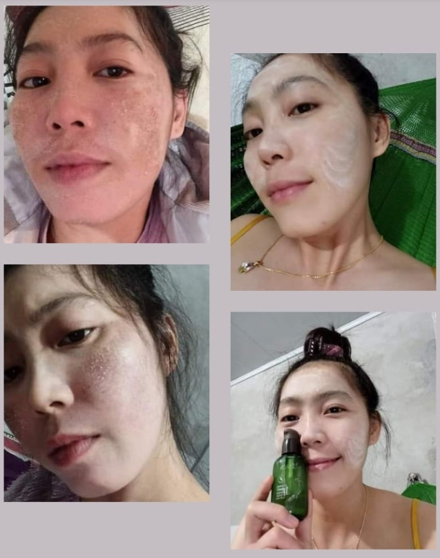 Cách giảm sưng khi tái tạo da nhân sâm mq skin Cách giảm sưng khi tái tạo da nhân sâm mq skin
