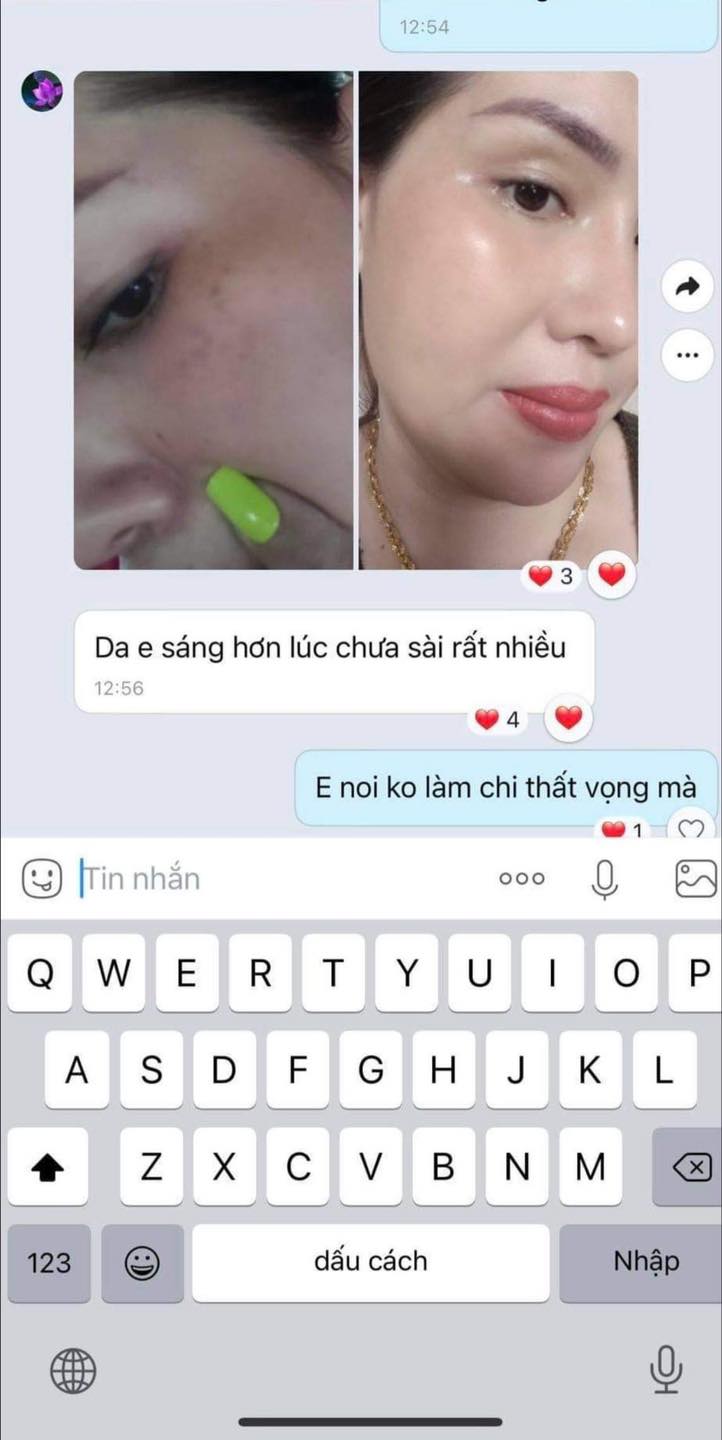 Da khách sau khi dùng bộ nám mq skin Da khách sau khi dùng bộ nám mq skin