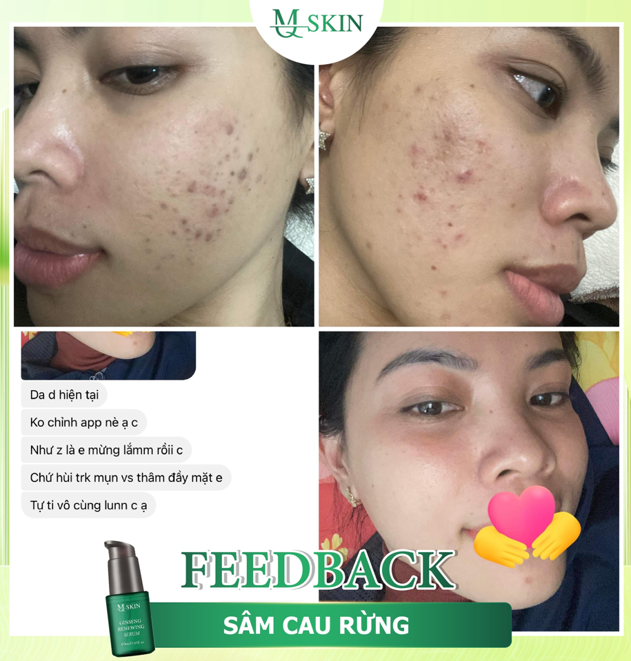 Feedback serum tái tạo da sâm cau rừng mq skin Feedback serum tái tạo da sâm cau rừng mq skin