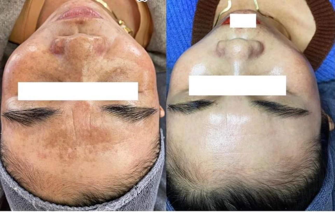 feedback khách sau khi dùng bộ nám mq skin feedback khách sau khi dùng bộ nám mq skin