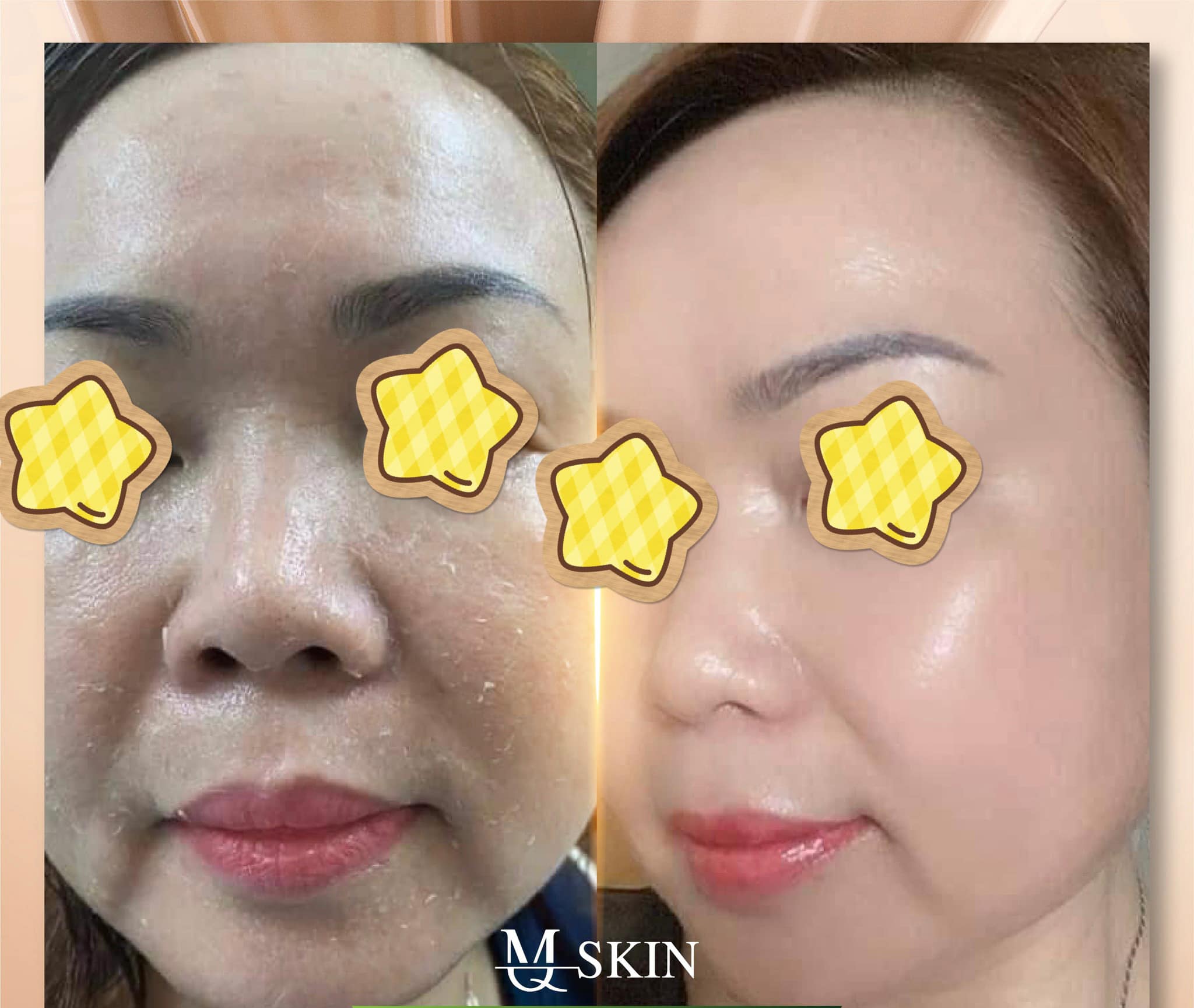 Kem tái tạo da nội sinh mq skin Kem tái tạo da nội sinh mq skin