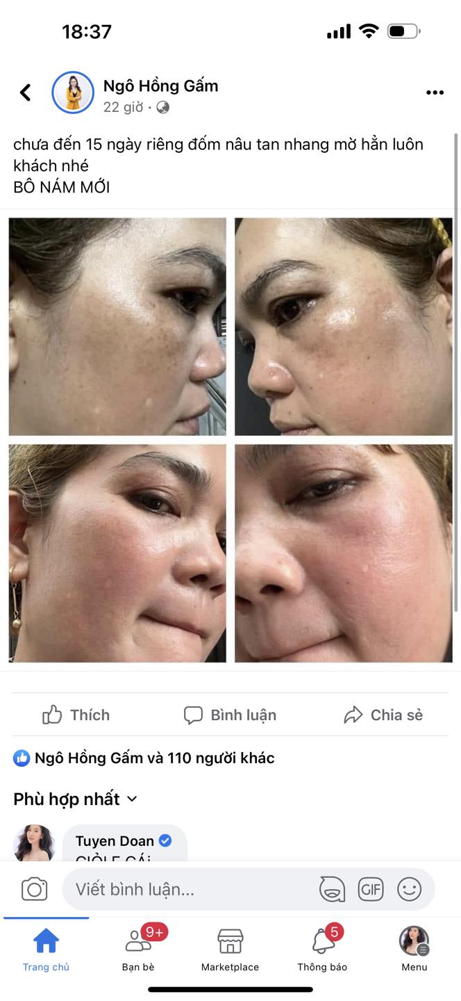 Khách hàng sau khi dùng bộ nám mq skin Khách hàng sau khi dùng bộ nám mq skin