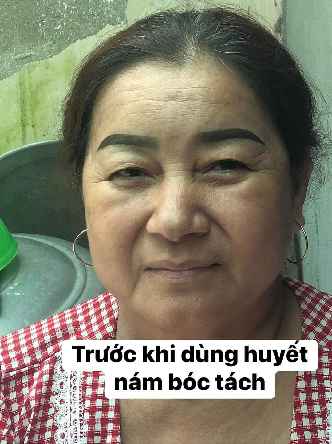 Khách trước khi dùng kem nám queenie Khách trước khi dùng kem nám queenie