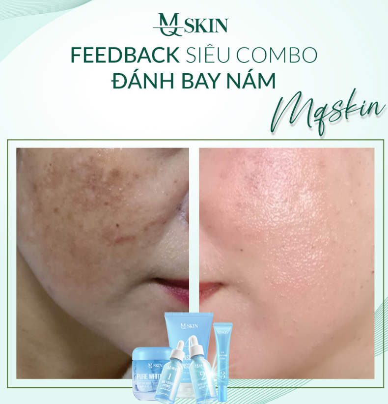 Phản hồi khách hàng dùng bộ trị nám mq skin Phản hồi khách hàng dùng bộ trị nám mq skin