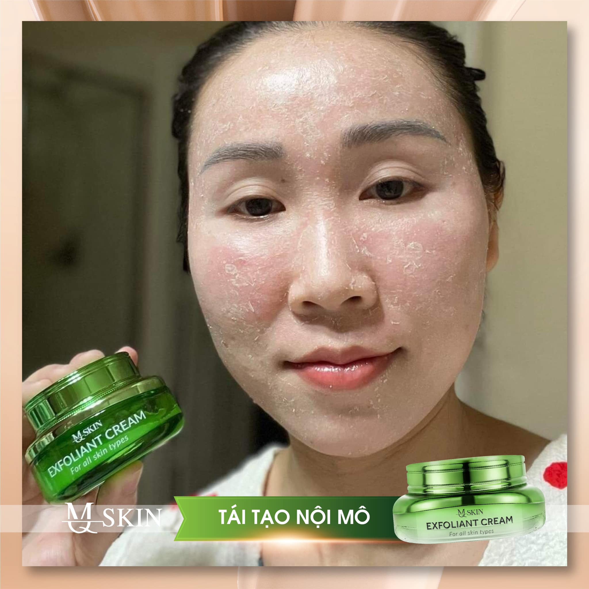 Sài kem tái tạo da nội mô mq skin khi nào ngưng Sài kem tái tạo da nội mô mq skin khi nào ngưng