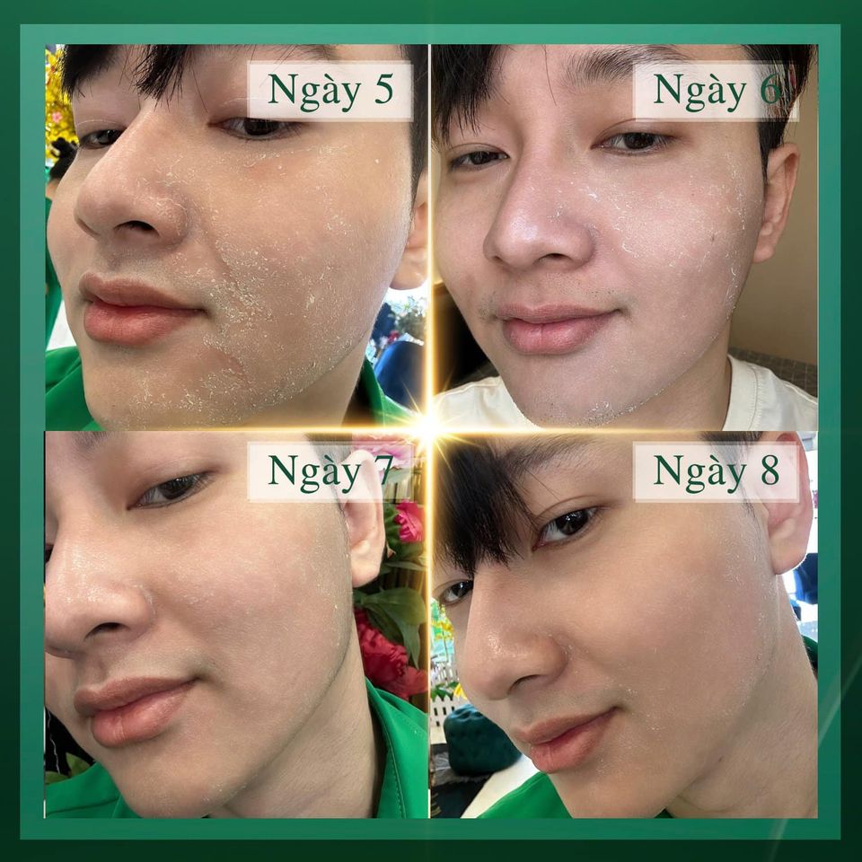 Thành phần kem tái tạo da nội mô mq skin Thành phần kem tái tạo da nội mô mq skin