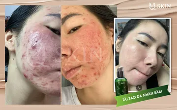 Cách Giảm Sưng Khi Tái Tạo Da Nhân Sâm MQ Skin