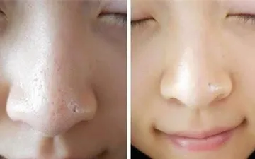 Thói Quen Gây Lỗ Chân Lông Bít Tắt Mụn Đầu Đen Nhiều