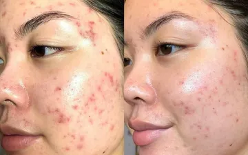 Cách Xử Lý Da Bị Dị Ứng Retinol