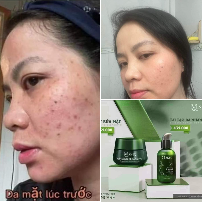 Xài tái tạo da mq skin khi nào ngưng Xài tái tạo da mq skin khi nào ngưng