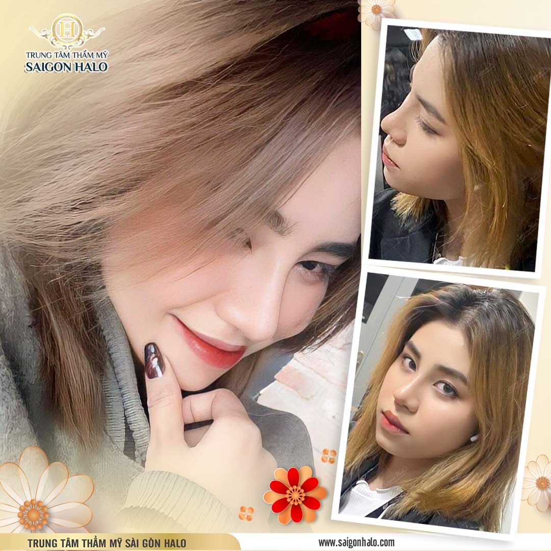 hình nâng mũi đẹp