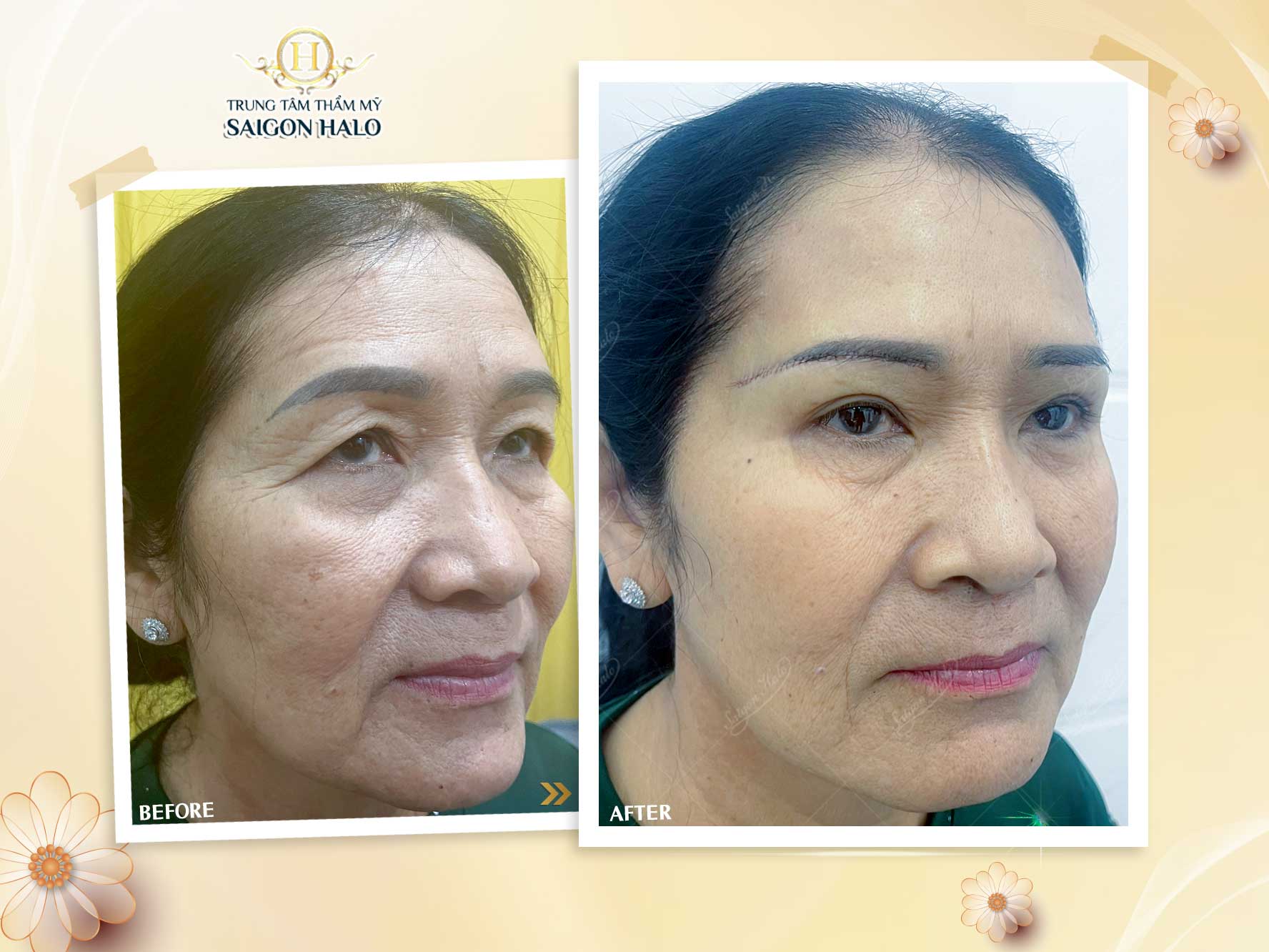 thẩm mỹ vùng mắt