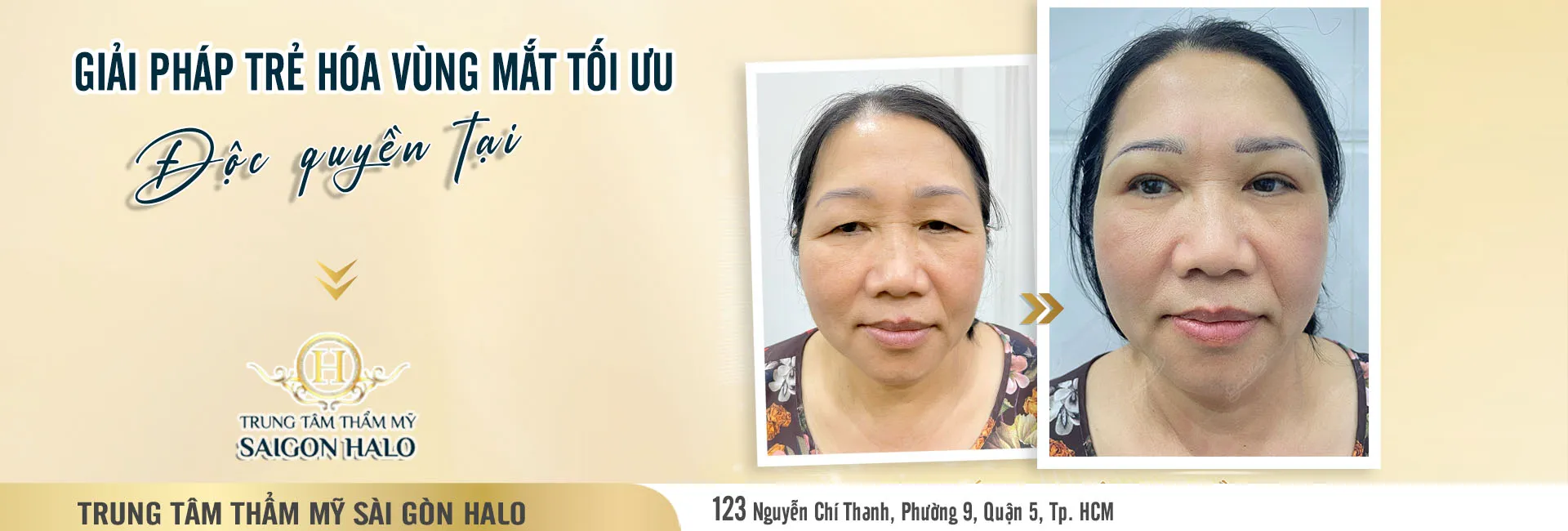 Cắt treo chân mày trẻ hóa vùng mắt tại Thẩm mỹ Sài Gòn Halo