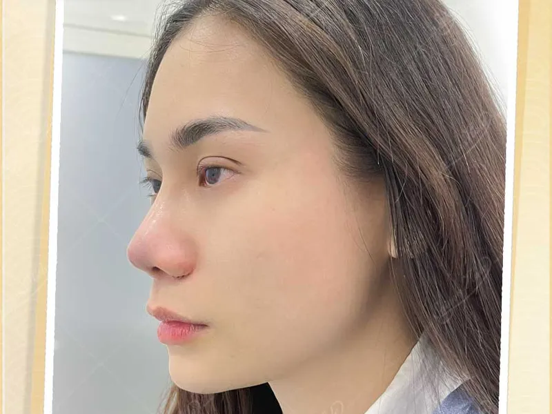 Trải nghiệm dịch vụ nâng mũi chất lượng cao tại Sài Gòn Halo