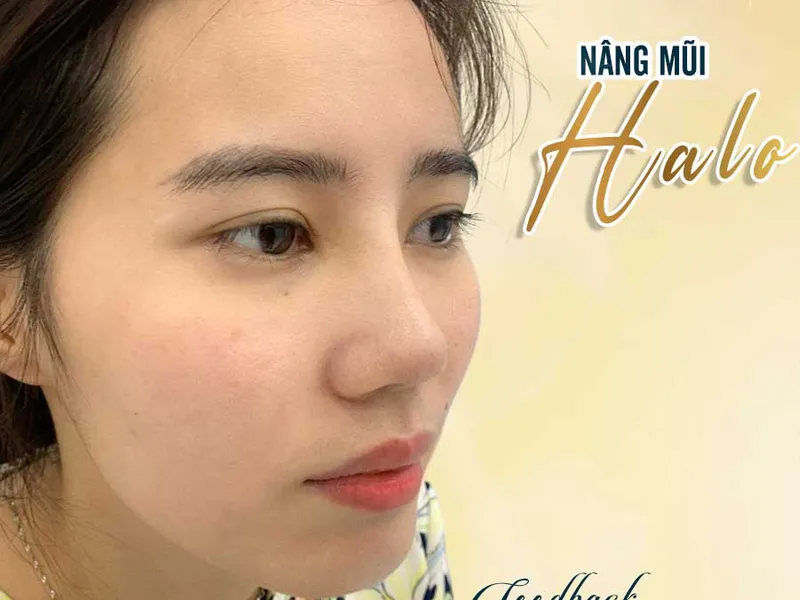 Nâng mũi đẹp tự nhiên bởi chuyên gia thẩm mỹ tại Sài Gòn Halo