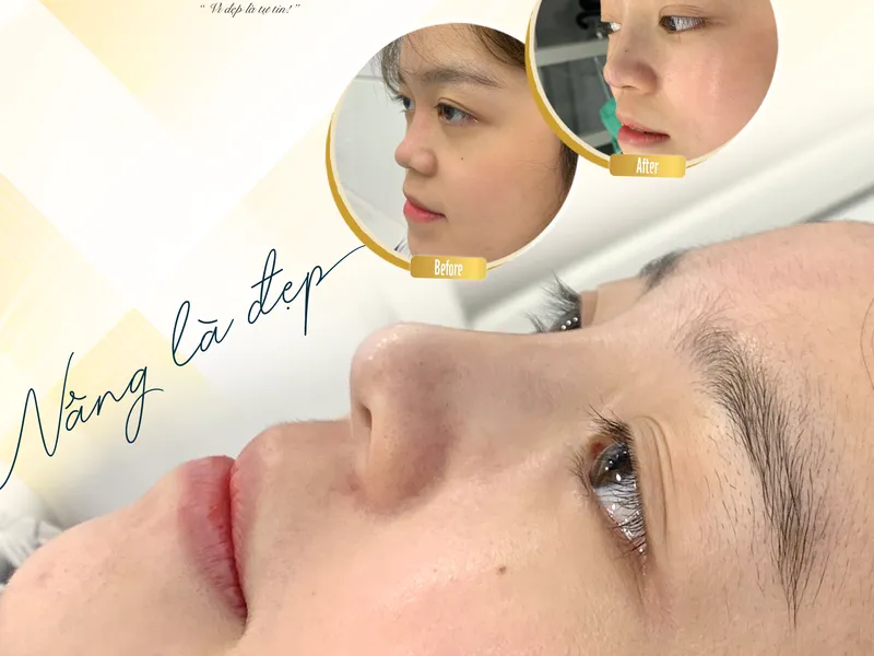 Có mấy loại phương pháp nâng mũi? Cái nào an toàn và không đau?