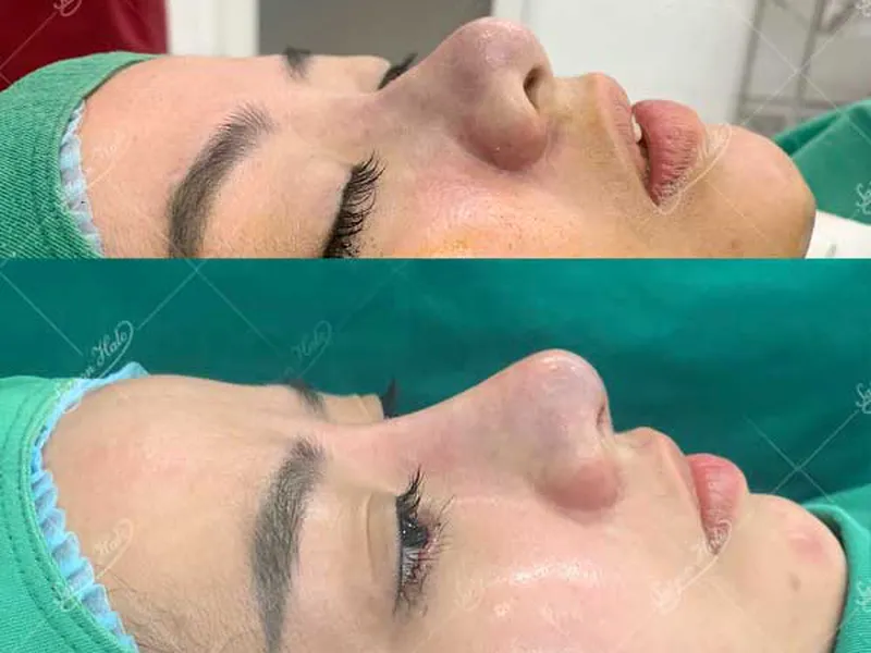 Phẫu thuật nâng mũi tại Sài Gòn Halo và những lợi ích thần kỳ